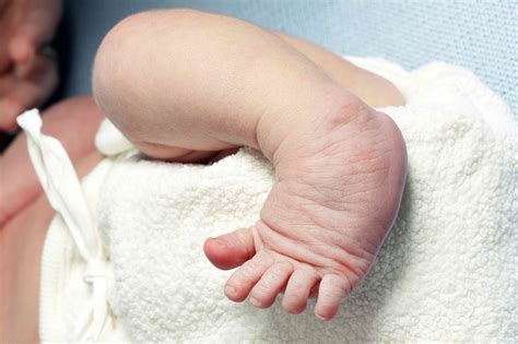 Causes And Treatment Of Orthopedic Problems In Newborns