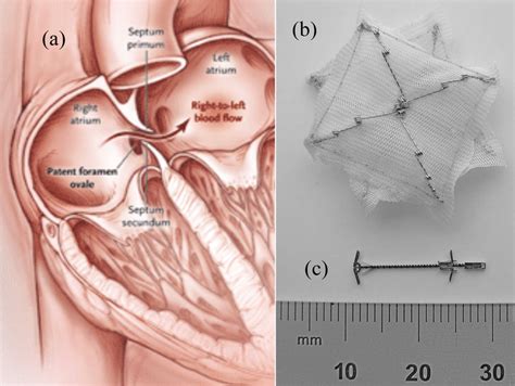 Patent Foramen Ovale Pfo And Closure Devices A Pfo Blood