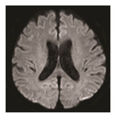 Brain Mri Taken On Day 29 A B Cranial T2 Weighted Flair Mri Download Scientific Diagram