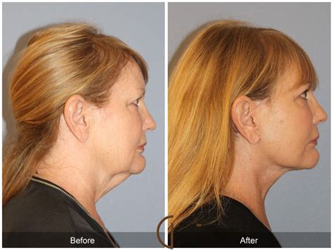 Neck Lift Before And After Photos Patient 39 Dr Kevin Sadati