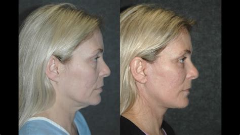 Facelift Surgery After Parotidectomy Dr Andrew Jacono Reviews Best