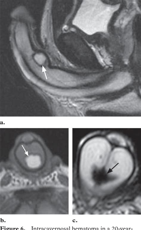 Figure 6 From Mr Imaging Of Nonmalignant Penile Lesions Semantic Scholar