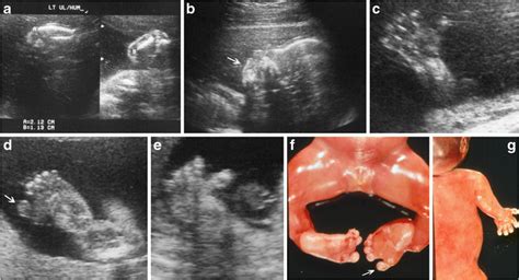 Evaluating Skeletal Dysplasias On Prenatal Ultrasound An Emphasis On Predicting Lethality