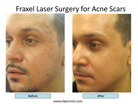 Fastest Acne Treatment Acne Scars On Face Treatment Fraxel Laser