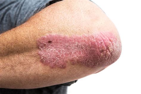 Death Risk Almost Doubles With Severe Psoriasis Study Suggests