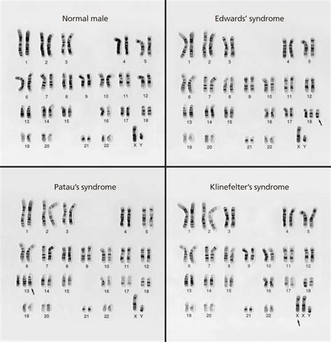 Chromosomal Abnormalities Chromosome Karyotype Gambaran
