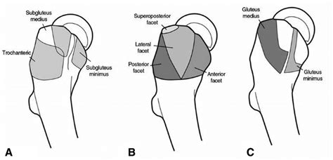 Illustrations Depicting Sagittal Anatomy Of The Greater Trochanter A