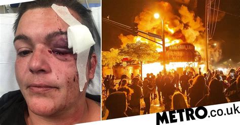 Journalist Blinded In One Eye During George Floyd Protests Metro News