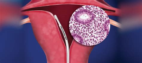 What Is Endometrial Biopsy For Tbpcr Why Is It Done