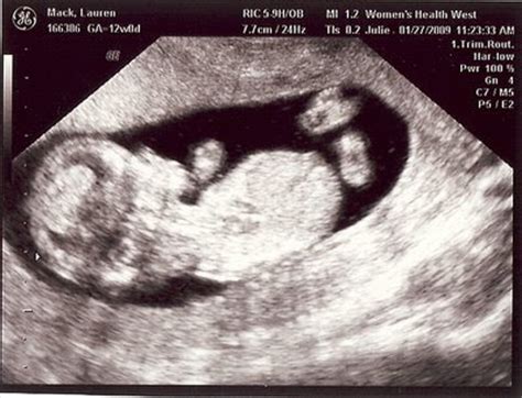 Although you cannot feel it yet, you can see the baby during a sonogram screening (ultrasound). The Mack Family: 12 Weeks