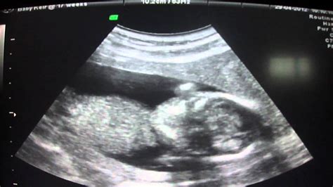17 Weeks Baby Gender Scan Babybonds Ultrasounds And 4d Youtube
