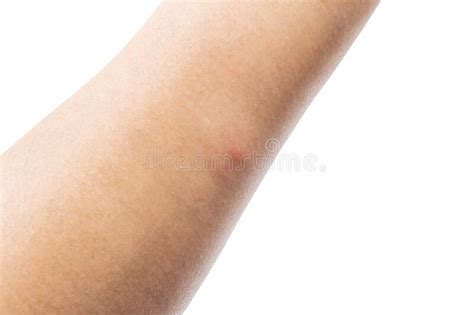 Photo Of Red Spot Swollen And Allergies From Insect Bites On Human Arm