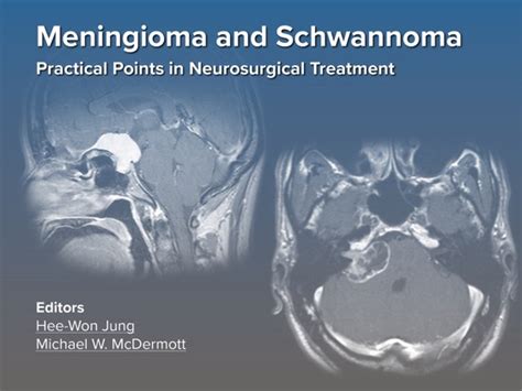 ‎falcotentorial Meningioma Supra And Infratentorial Combined Approach