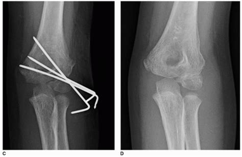 Lateral Condyle Fractures Musculoskeletal Key