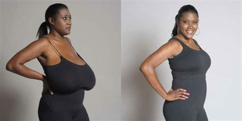 Gigantomastia Woman S Breasts Grow To 36NNN