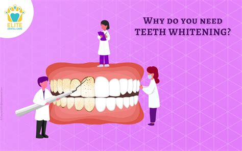 Why do you need teeth whitening? - Elite Dental Care