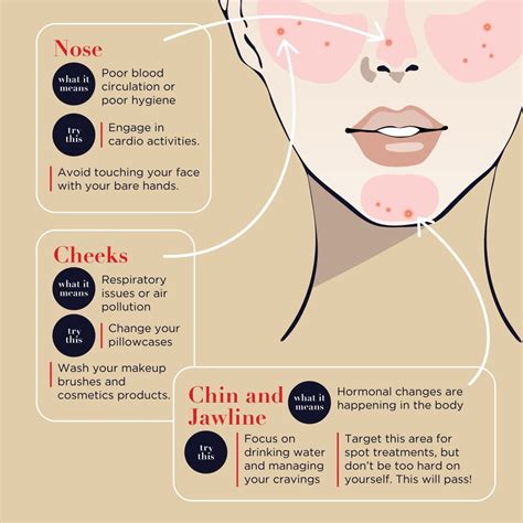 Types Of Acne Causes And Treatment Infographic Tips For Natural Beauty