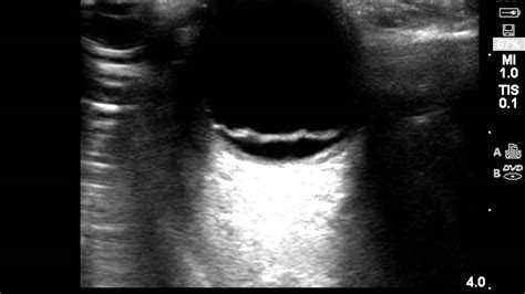 This complex surgery involves replacing the vitreous (the clear gel in the center of the eye) with a saline (salt) solution. Ocular Ultrasound: Retinal Detachment - YouTube