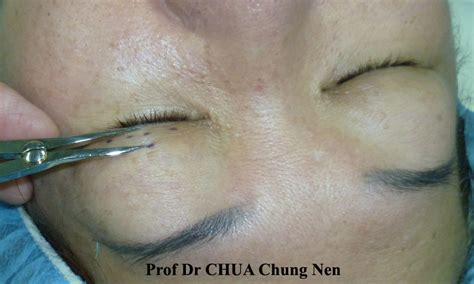 Eyelid Surgery By Prof Dr Cn Chua Doctor Why Are My Double Eyelids Unequal Part Ii