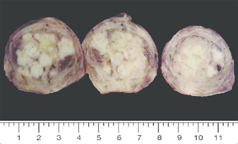 B Macroscopic Image Of Uterine Angioleiomyoma The Cut Sections Of The