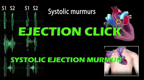 Ejection Click And Systolic Ejection Murmur Pf Heart Sound Youtube