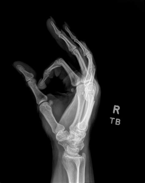Orthodx Finger Injury From Punch Impact Clinical Advisor