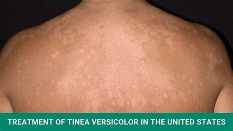 Tinea Versicolor Causes Signs Symptoms Treatment 40 Off