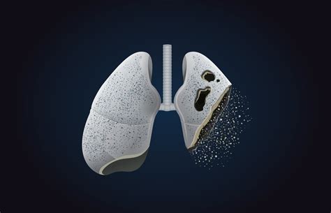 Your lungs are two spongy organs in your chest that take in oxygen when you inhale and release carbon dioxide when you exhale. 7 Symptoms of Lung Cancer | Onco.com