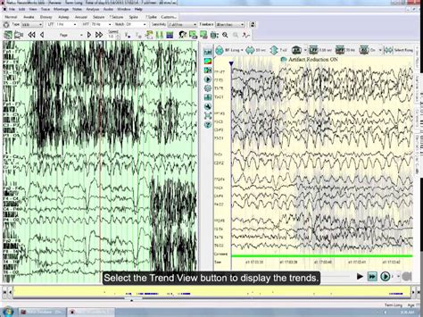 Introduction To Persyst 12 On Natus Neuroworks Eeg Youtube