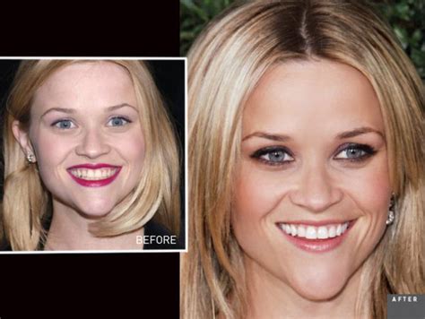 Reesewitherspoon Cosmeticdentistry Beforeandafter