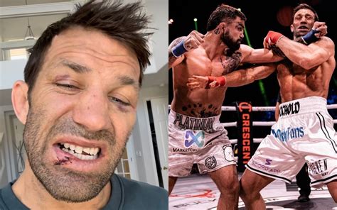 Bkfc 41 Watch Luke Rockhold Shows Off Broken Tooth And Stitched Up