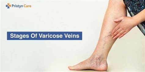 Varicose Veins Stages Pristyn Care