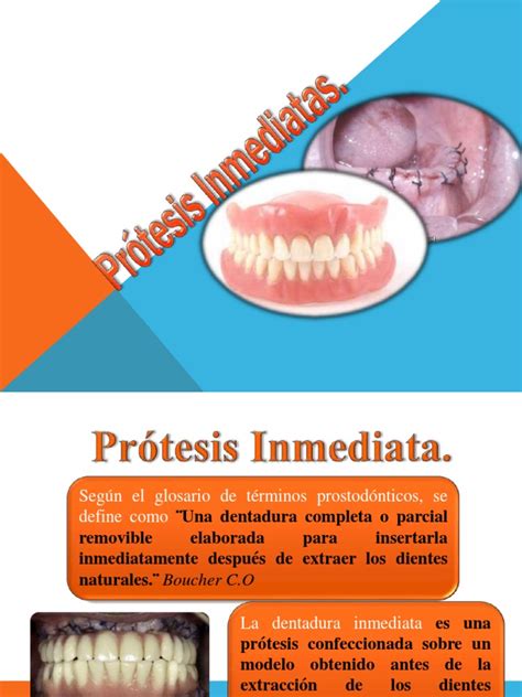 Protesis Inmediata Pdf Dentadura Postiza Odontología