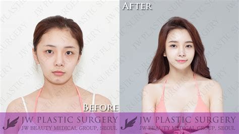 Fat grafting in korea has become a popular procedure for people to look youthful as well as for those looking to correct certain parts of their body shape. JW Plastic Surgery Korea Nose Surgery and Fat Grafting ...