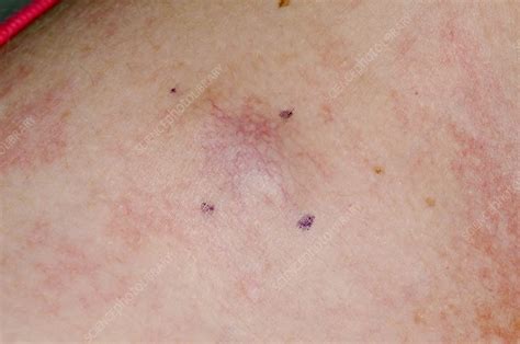 Melanoma Skin Cancer On Chest