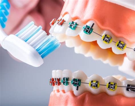 Braces Care And Oral Hygiene Flower Mound Tx Orthodontist