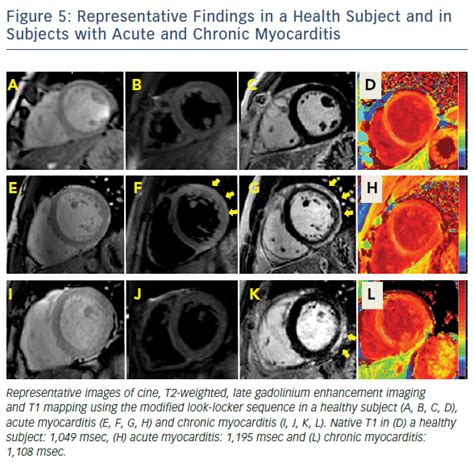 Imaging findings were retrospectively compared to the discharge diagnoses. Cardiovascular MRI Quantitative Tissue | ECR Journal