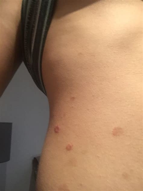 Weird Rash On The Right Of My Torso Medical