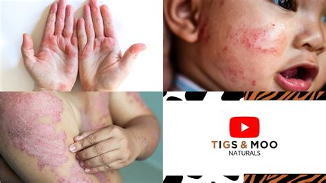 How Do I Know If I Have Eczema Different Types Of Eczema Tigs And Moo