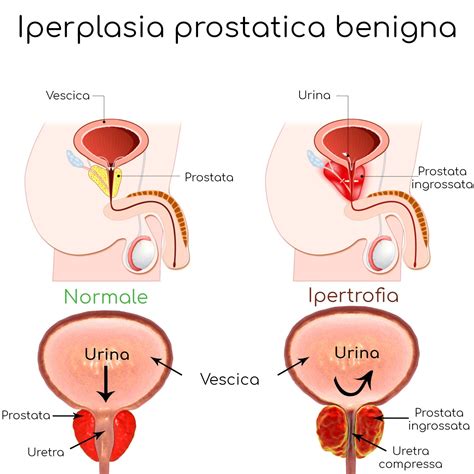 I Sintomi Della Prostata Ingrossata Ipertrofia Prostatica Benigna Valori Normali