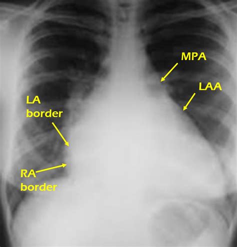 X Ray Chest Pa View Showing Biatrial Enlargement All About