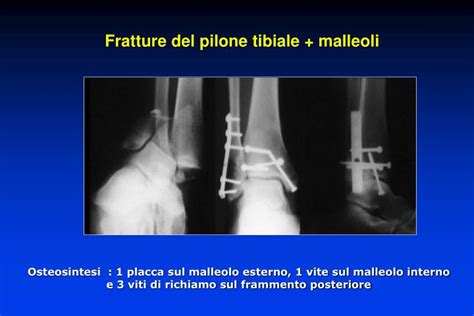 PPT - Traumatologia della caviglia PowerPoint Presentation ...