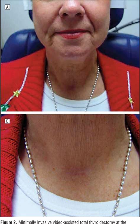 Figure 2 From Minimally Invasive Video Assisted Thyroidectomy A Multi