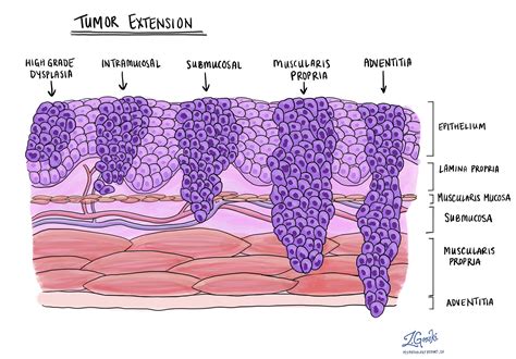 Squamous Cell Carcinoma Of The Esophagus Mypathologyreport Ca My XXX