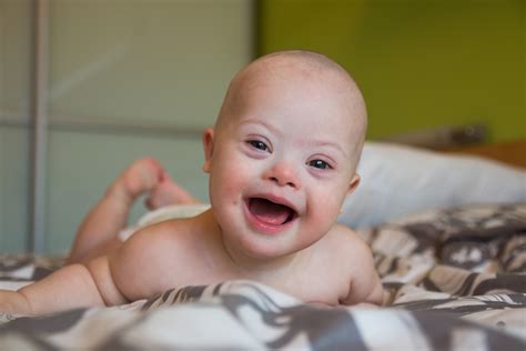 Baby Born With Down Syndrome