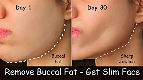 Remove Buccal Fat Lose Face Fat With Jawline Exercise Get Slim Face Sharp Jawline V Shape