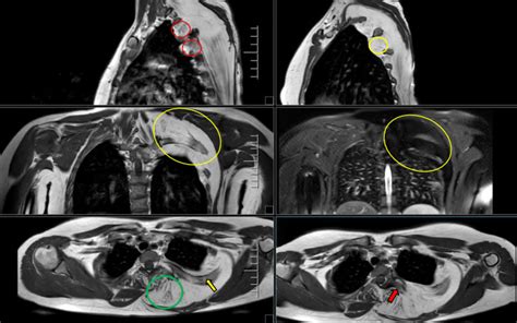 Mri Images Of Chest Showing Intercostal Nerve Hypertrophy With