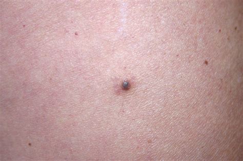 Worried About Your Moles Heres How To Tell If Your Mole Could Turn Cancerous