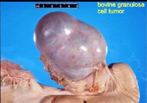 Medical Pictures Info Granulosa Cell Tumor