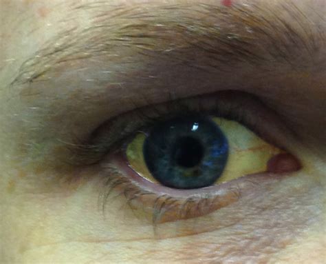 My eyes are yellow in this morning. Hepatitis — Middlesex-London Health Unit